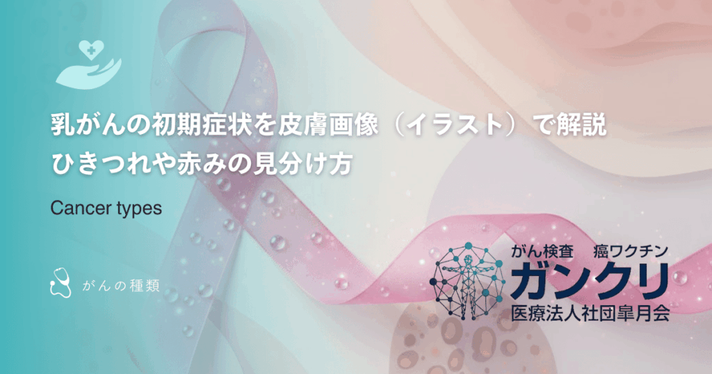 乳がんの初期症状を皮膚画像（イラスト）で解説｜ひきつれや赤みの見分け方