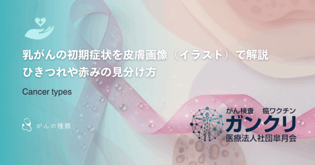 アブスコパル効果とは？放射線治療と免疫療法の併用で期待される全身への影響