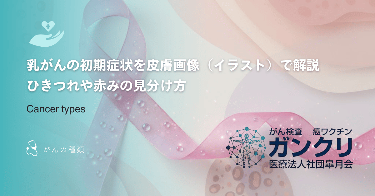 乳がんの初期症状を皮膚画像（イラスト）で解説｜ひきつれや赤みの見分け方