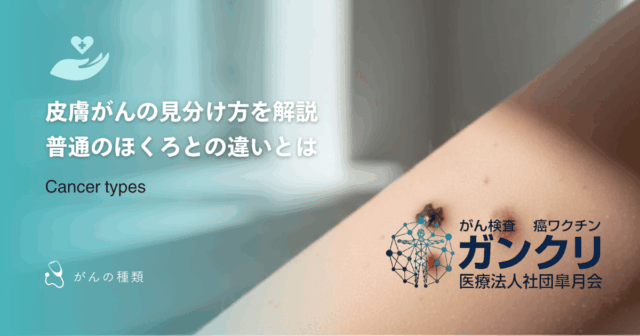 皮膚がんの見分け方を解説｜普通のほくろとの違いとは