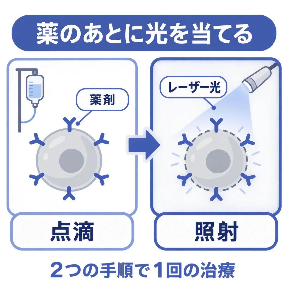 点滴で薬剤を届けた翌日にレーザー光を照射し、薬剤が結びついた細胞膜を傷つける二段階の治療図
